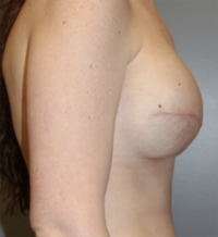 Skin Sparing Reconstruction