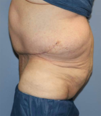 Panniculectomy