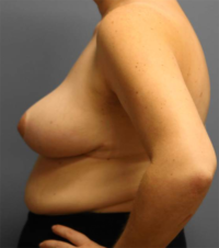 Breast Reduction