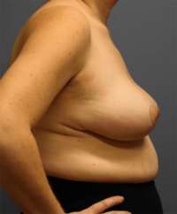 Breast Reduction