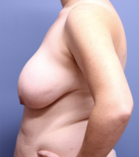 Breast Reduction