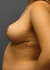 Breast Reduction
