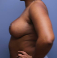 Breast Reduction