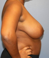 Breast Reduction