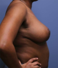Breast Reduction