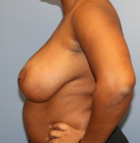 Breast Reduction