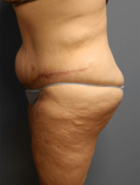 Panniculectomy