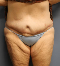 Panniculectomy