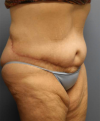 Panniculectomy