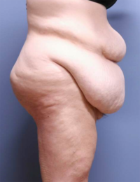 Panniculectomy