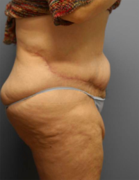 Panniculectomy
