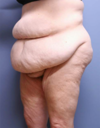 Panniculectomy