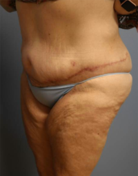 Panniculectomy