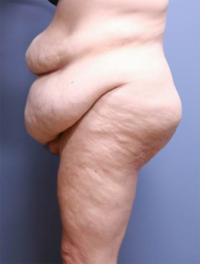 Panniculectomy