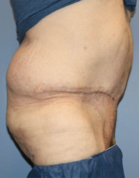 Panniculectomy