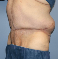 Panniculectomy