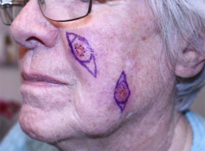 Before Skin Cancer and Mohs Reconstruction