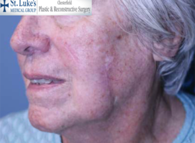 After Skin Cancer and Mohs Reconstruction