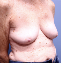 Breast Implant Removal