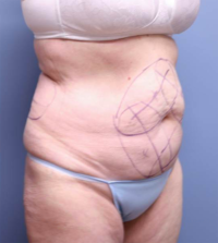 CoolSculpting