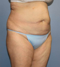 CoolSculpting