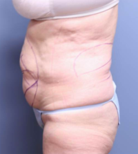 CoolSculpting