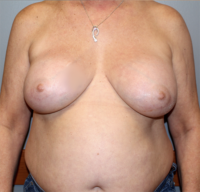 Breast Implant Removal