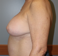 Breast Implant Removal