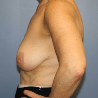 Oncoplastic Breast Reconstruction