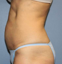 CoolSculpting