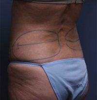 CoolSculpting