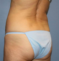 CoolSculpting