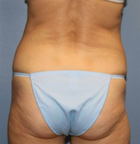 CoolSculpting