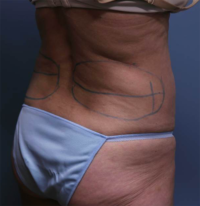 CoolSculpting