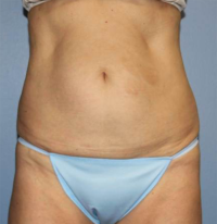 CoolSculpting