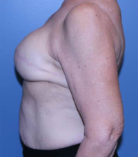 Skin Sparing Reconstruction