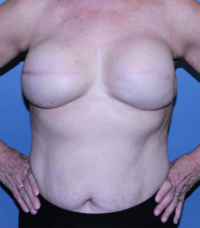 Skin Sparing Reconstruction