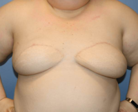 Oncoplastic Breast Reconstruction