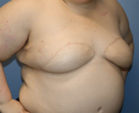 Oncoplastic Breast Reconstruction