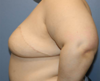 Oncoplastic Breast Reconstruction