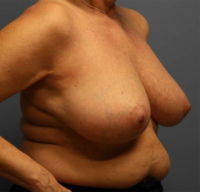 Breast Lift