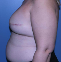 Skin Sparing Reconstruction