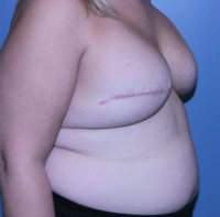 Skin Sparing Reconstruction