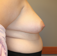 Skin Sparing Reconstruction