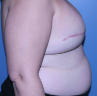 Skin Sparing Reconstruction