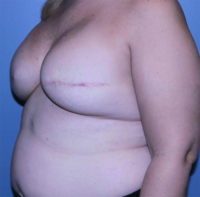 Skin Sparing Reconstruction