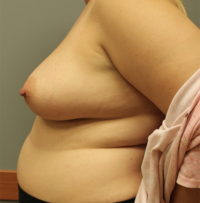 Skin Sparing Reconstruction