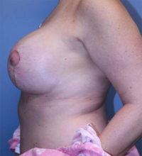 Breast Lift with Augmentation