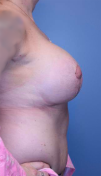 Breast Lift with Augmentation