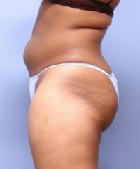 CoolSculpting